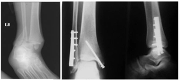 Ayak Bileği Kırıkları Ameliyatı Riskleri ve Sonrası Ayak Bileği Kırıkları Ameliyatı Riskleri ve Sonrası