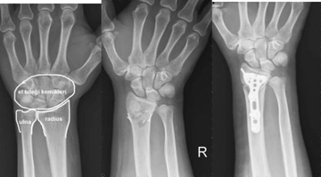 Bilek Çatlağı Belirtileri ve Tedavisi