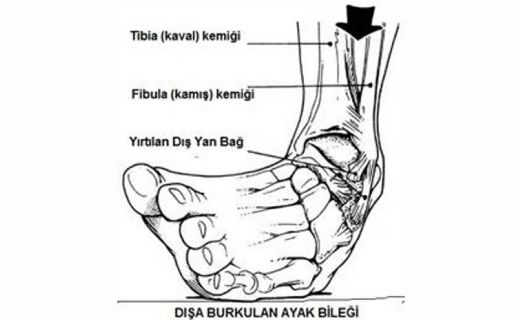 Ayak Bilei Kkrdak Zedelenmesi