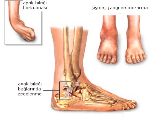 Ayak Bilei Tendon Zedelenmesi