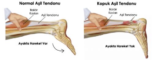 Ayak Tendon Zedelenmesi