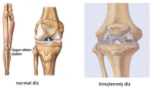 Kkrdak Zedelenmesi