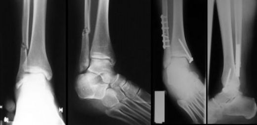 Lateral Malleol Kr