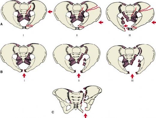 Pelvis Krklar