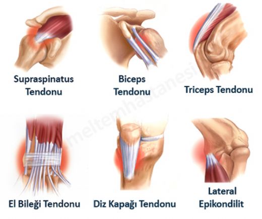 Tendon Zedelenmesi